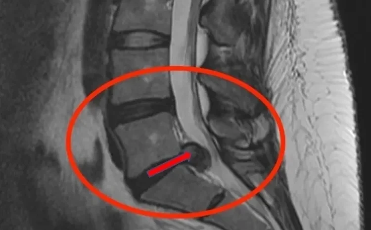 POSSUI HÉRNIA DE DISCO E NERVO CIÁTICO INFLAMADO